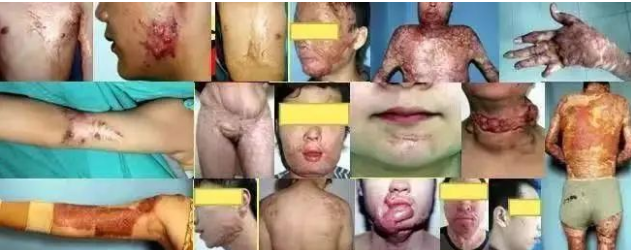 【蔡教授疤痕科普】疤痕疙瘩能治愈吗？多久能痊愈？治疗后复发怎么办？