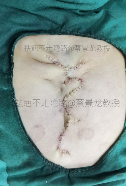 【蔡教授瘢痕治疗科普】疤痕切除缝合后切口周围为何会鼓起来？哪些疤痕必须要手术治疗？