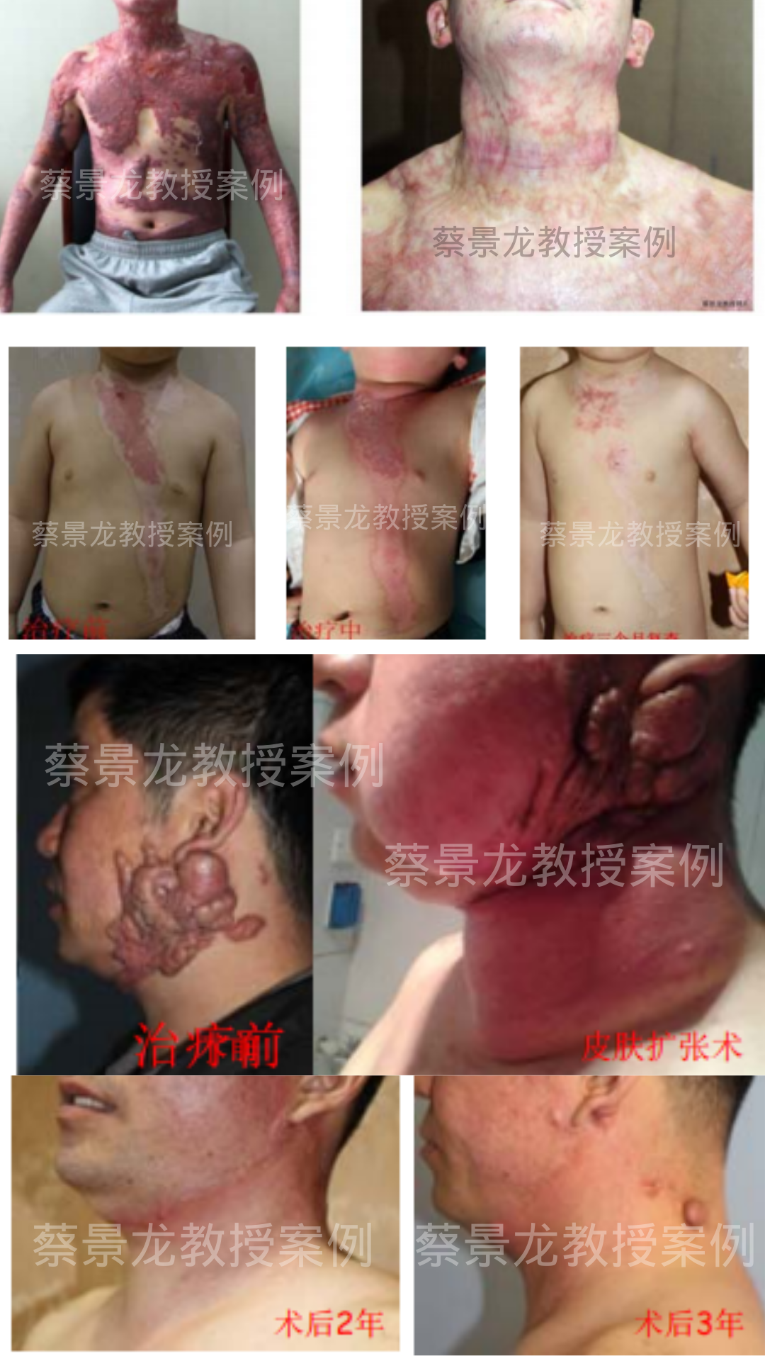 蔡景龙教授案例.png