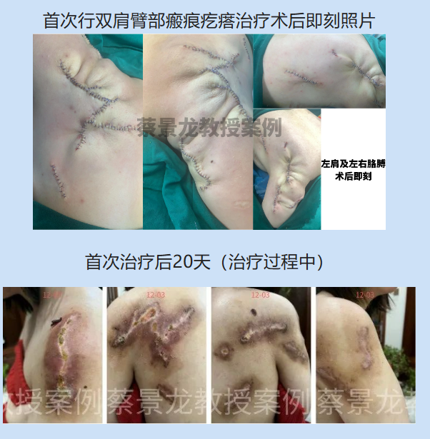 困扰24岁女孩7年的全身多发瘢痕疙瘩 ，在我院获得救助基金及费用减免，开启新的生活！