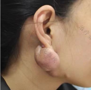 不同的方法治疗下颌耳部瘢痕疙瘩2年效果比较