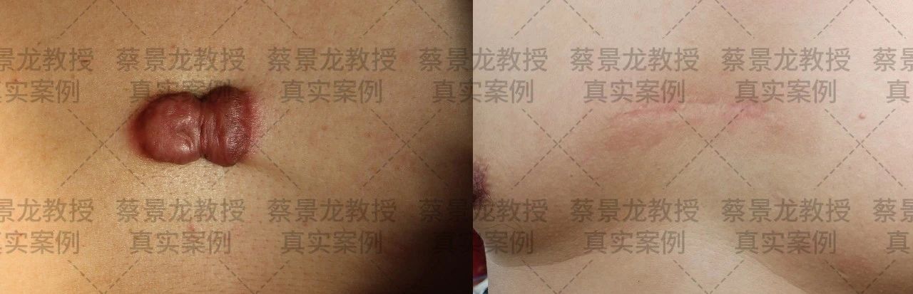 [蔡景龙治疤案例1016]50岁男性胸部痘疤30年蔡景龙治疤模式治疗后一年的效果