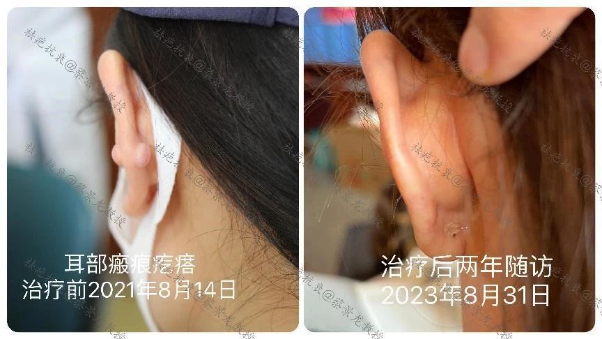 [蔡景龙治疤案例1017]24岁女性耳部痘疤治疗两年后的效果